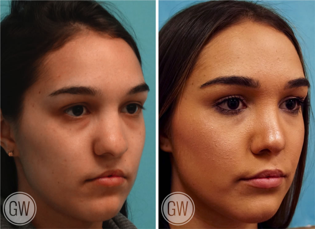 Cleft Rhinoplasty + Upper Lip Fat Grafting