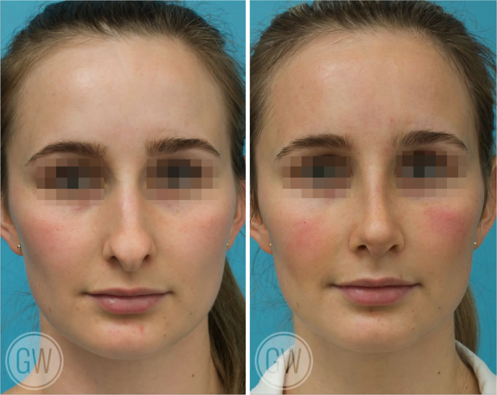 Rhinoplasty