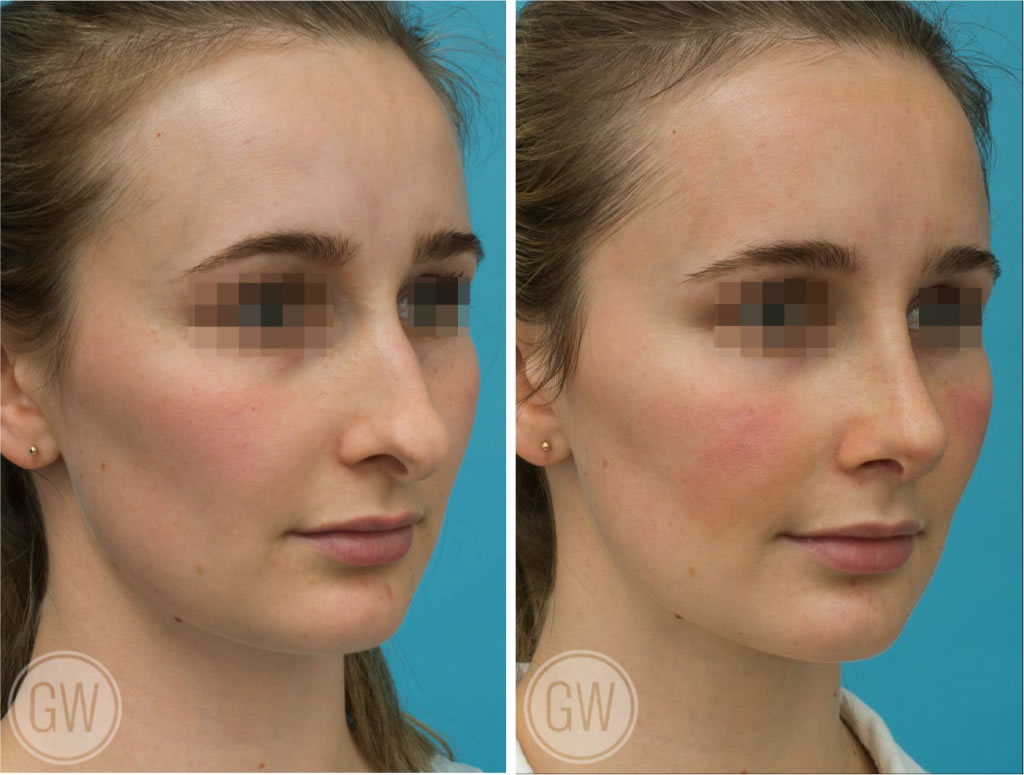 Rhinoplasty