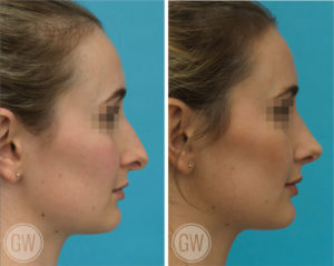 Rhinoplasty