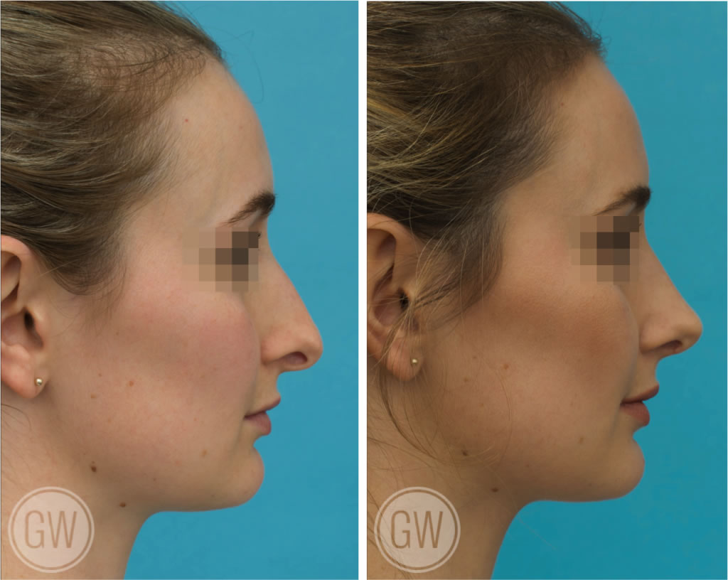 Rhinoplasty
