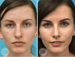 Rhinoplasty + Septoplasty + Turbinate Reduction