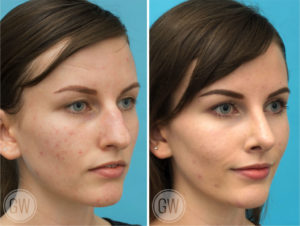 Rhinoplasty + Septoplasty + Turbinate Reduction