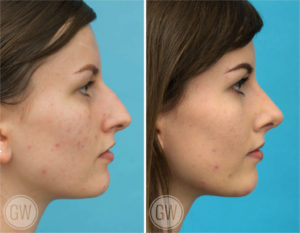 Rhinoplasty + Septoplasty + Turbinate Reduction