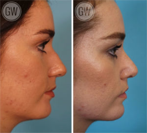 Rhinoplasty + Septoplasty