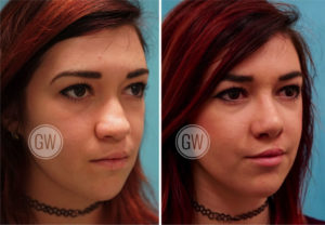 Cleft Rhinoplasty + Septoplasty + Lip Revision