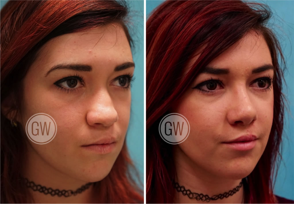 Cleft Rhinoplasty + Septoplasty + Lip Revision