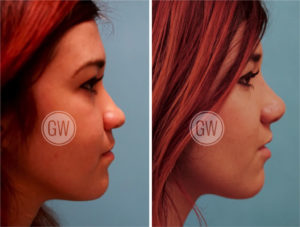 Cleft Rhinoplasty + Septoplasty + Lip Revision