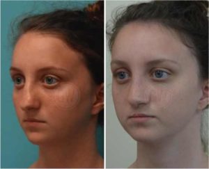 Complex Rhinoplasty + Septoplasty