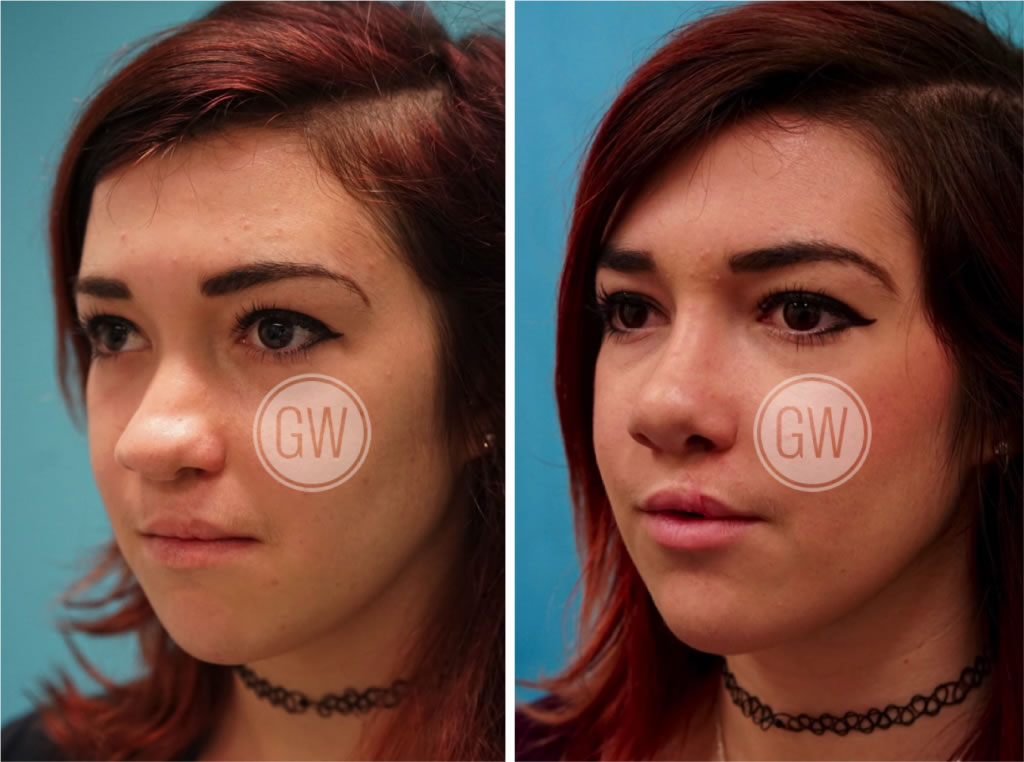 Cleft Rhinoplasty + Septoplasty + Lip Revision