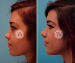 Cleft Rhinoplasty + Septoplasty + Lip Revision