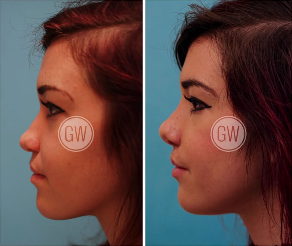 Cleft Rhinoplasty + Septoplasty + Lip Revision