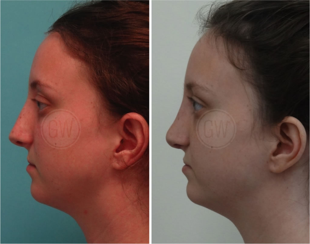 Complex Rhinoplasty + Septoplasty