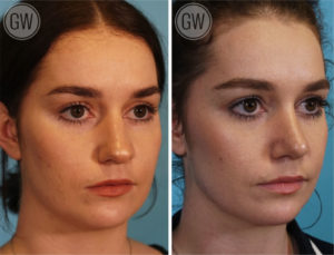 Rhinoplasty + Septoplasty