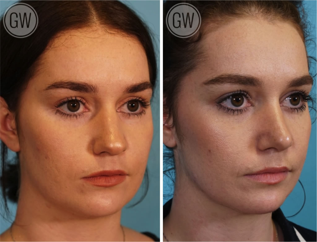 Rhinoplasty + Septoplasty