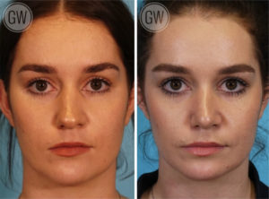 Rhinoplasty + Septoplasty
