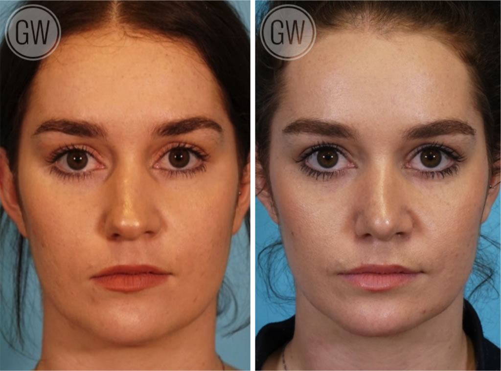 Rhinoplasty + Septoplasty