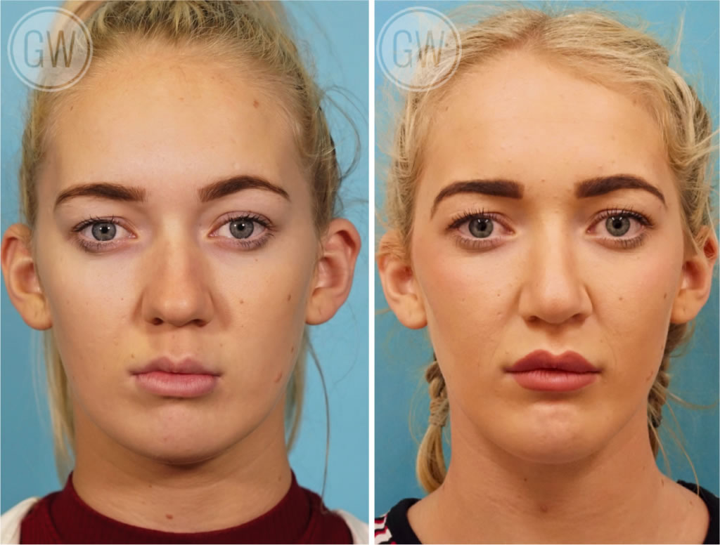 Rhinoplasty