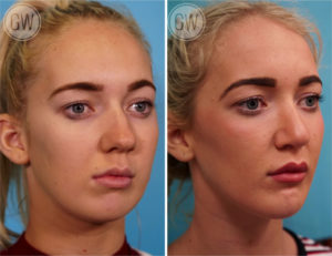 Rhinoplasty