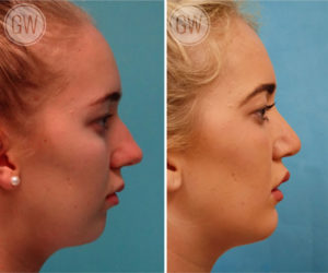 Rhinoplasty