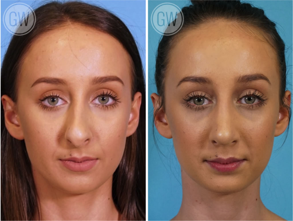 Rhinoplasty