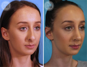 Rhinoplasty