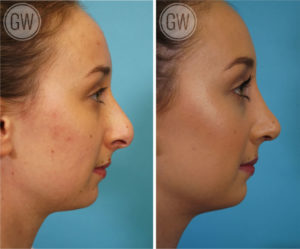 Rhinoplasty