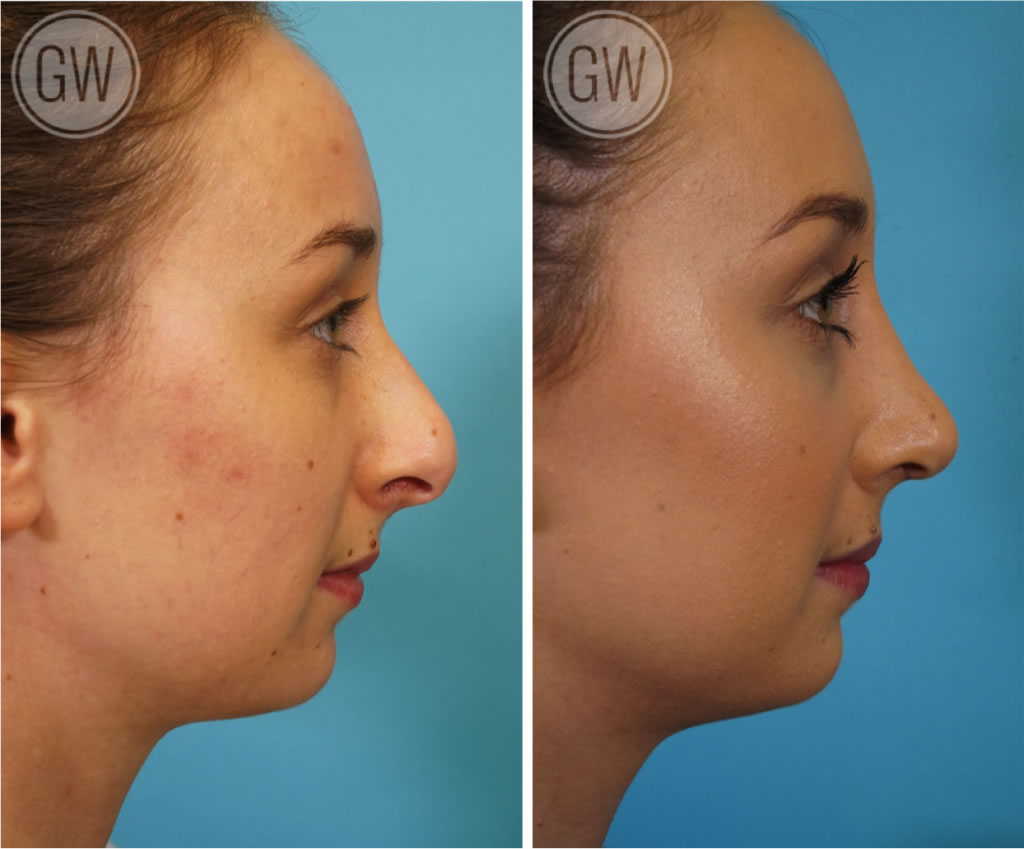 Rhinoplasty