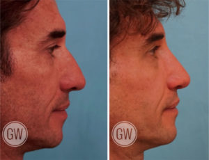 Reduction rhinoplasty