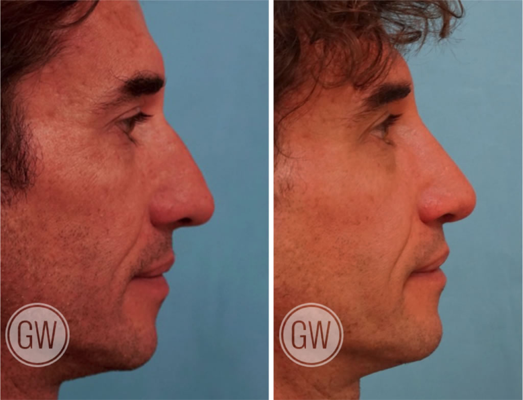 Reduction rhinoplasty