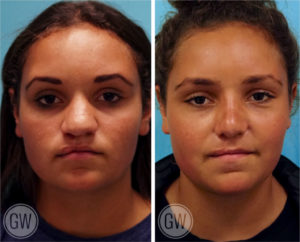 Cleft Rhinoplasty + Septoplasty