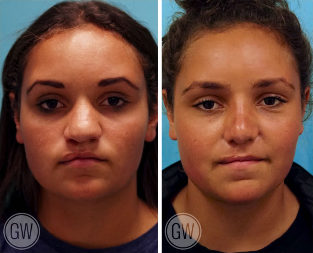 Cleft Rhinoplasty + Septoplasty