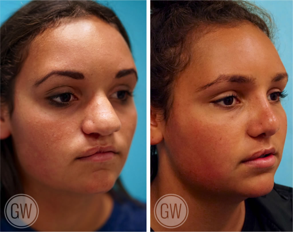 Cleft Rhinoplasty + Septoplasty
