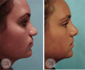 Cleft Rhinoplasty + Septoplasty