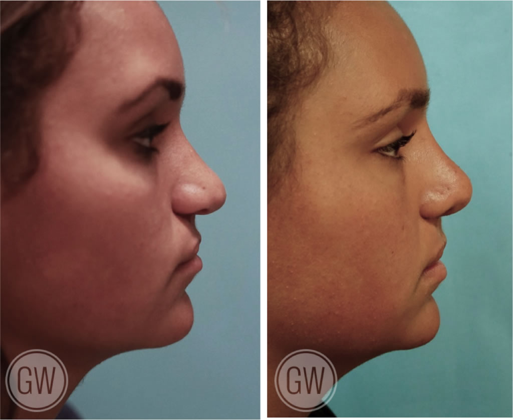 Cleft Rhinoplasty + Septoplasty