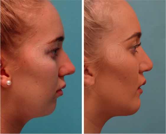 Rhinoplasty + Genioplasty