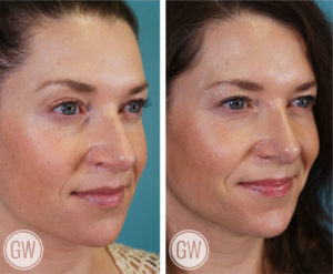 Rhinoplasty + Septoplasty