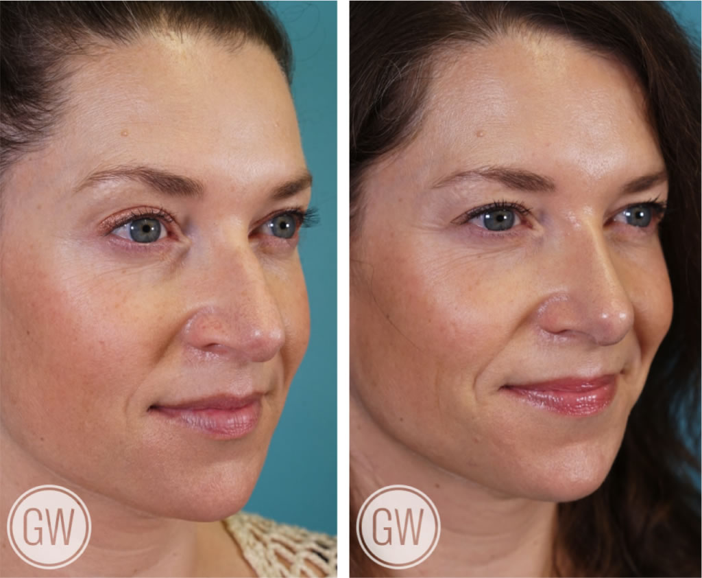 Rhinoplasty + Septoplasty