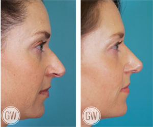 Rhinoplasty + Septoplasty