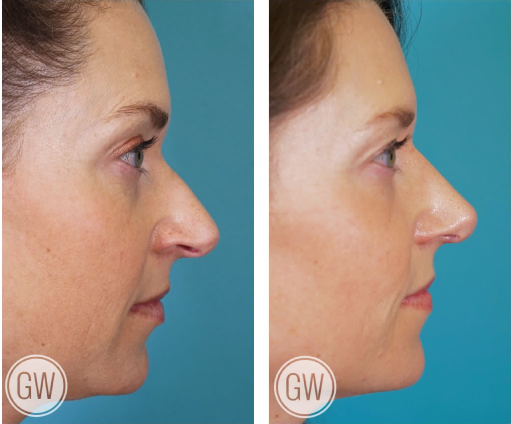 Rhinoplasty + Septoplasty