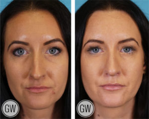 Rhinoplasty + Septoplasty + Lower Eyelid Blepharoplasty