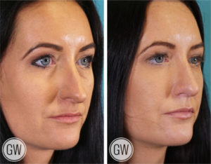 Rhinoplasty + Septoplasty + Lower Eyelid Blepharoplasty