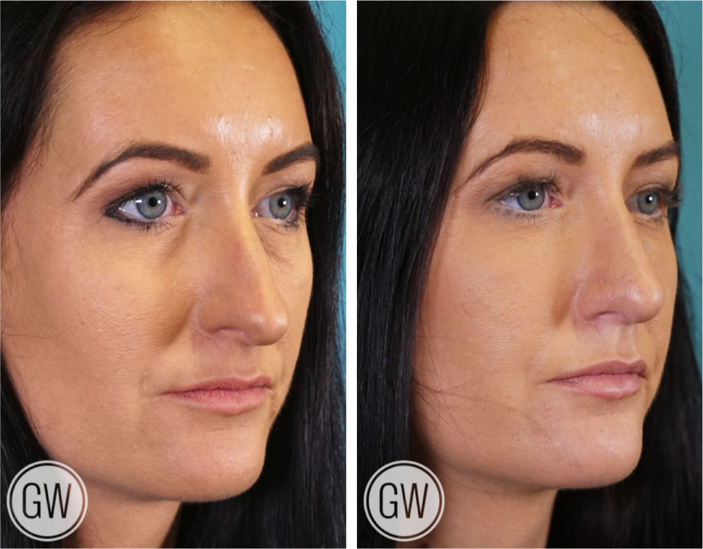 Rhinoplasty + Septoplasty + Lower Eyelid Blepharoplasty