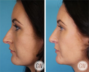 Rhinoplasty + Septoplasty + Lower Eyelid Blepharoplasty