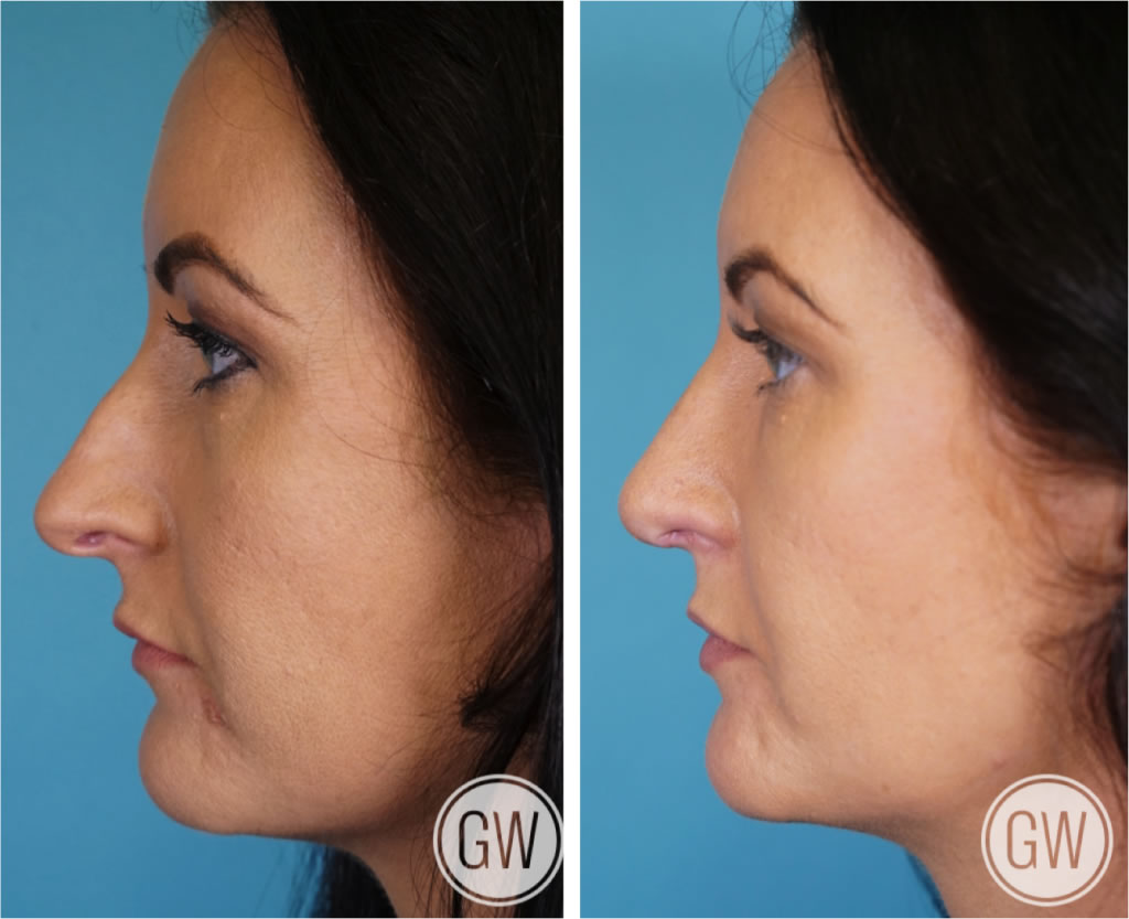 Rhinoplasty + Septoplasty + Lower Eyelid Blepharoplasty