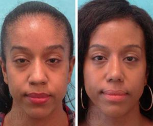 Reduction Rhinoplasty
