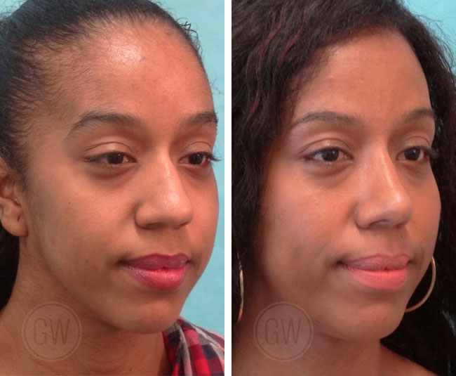 Rhinoplasty Gallery - Rhinoplastyperth