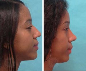 Reduction Rhinoplasty