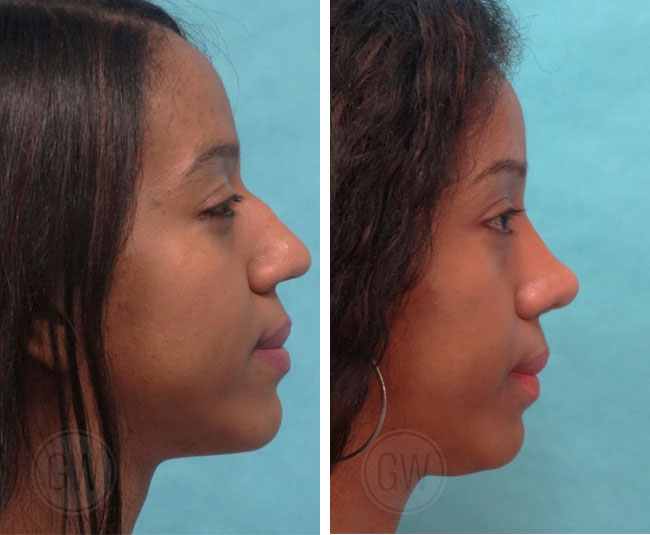 Reduction Rhinoplasty