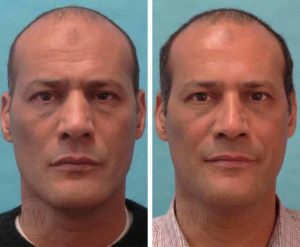 Rhinoplasty – Narrowing of nasal vault